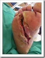 mercury-foot-injury-3 mercury-foot-injury-3